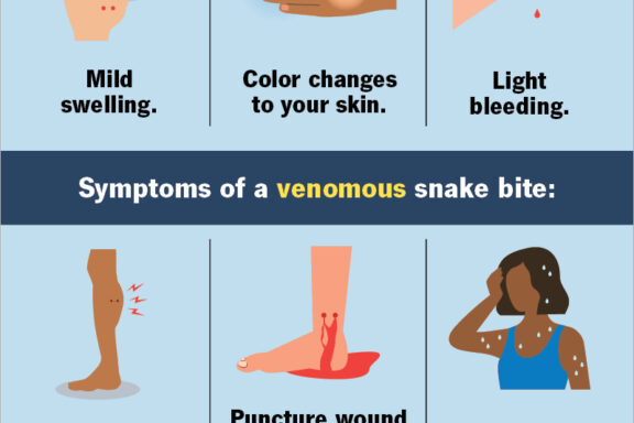 Burmese Python Bite: Treatment and Prevention